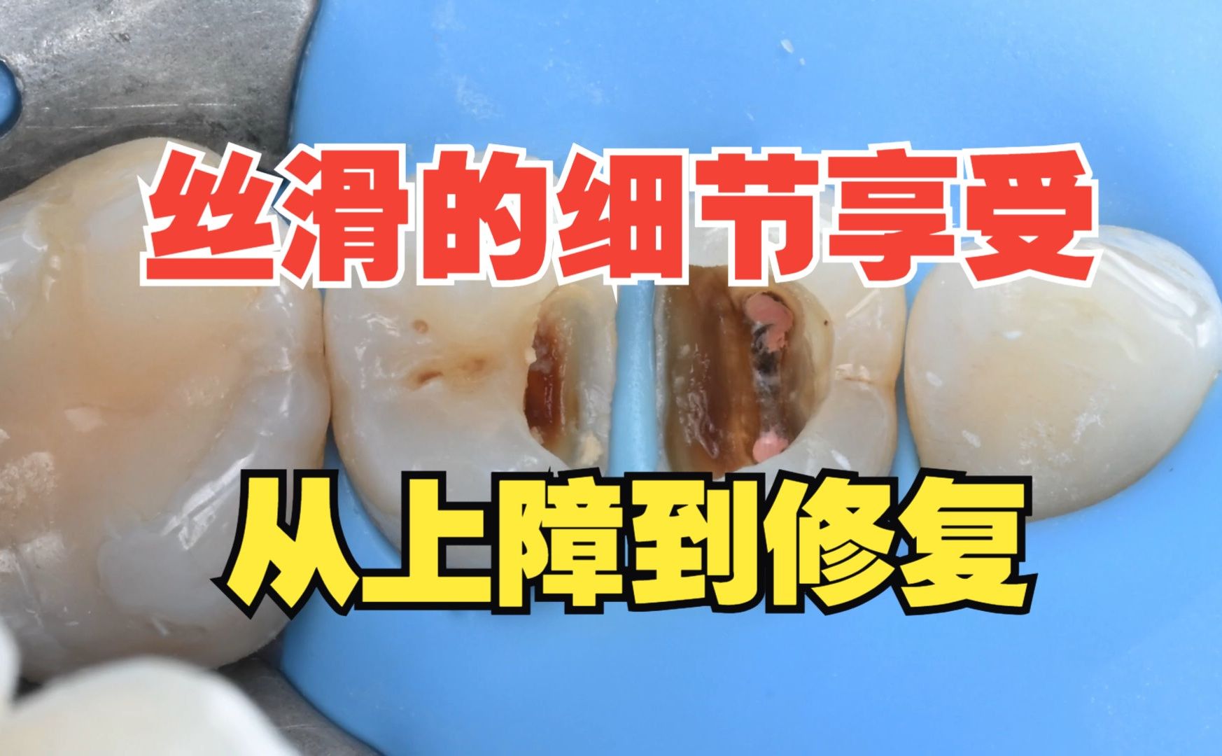 从上障到修复，丝滑的细节享受：HOW TO PREPARE A TOOTH FOR RE-ENDO TREATMENT